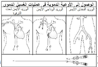 غسيل الكلى in Arabic Language