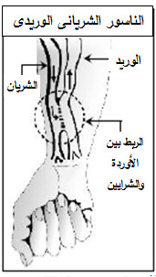 غسيل الكلى in Arabic Language