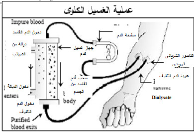 غسيل الكلى in Arabic Language