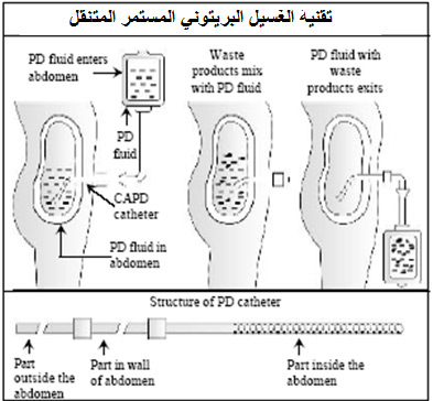 غسيل الكلى in Arabic Language