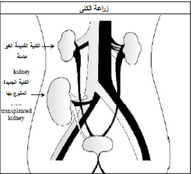 زرع الكلى in Arabic Language