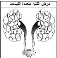 مرض الكلى المتعدد الكيسات in Arabic Language