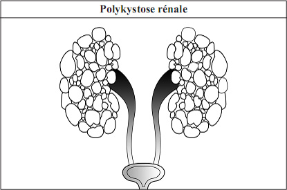 Polykystose rénale in French Language