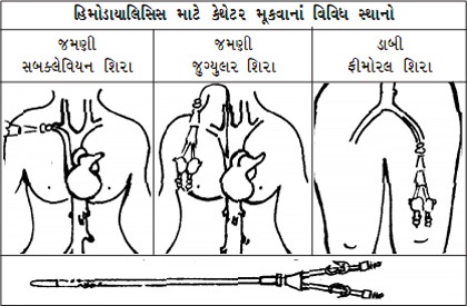 double lumen catheter