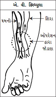 AV Fistula