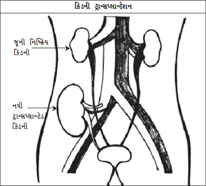 kidney transplantation surgery 