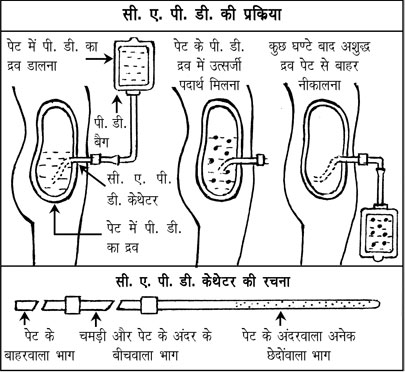 Kidney In Hindi
