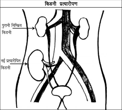 Kidney In Hindi