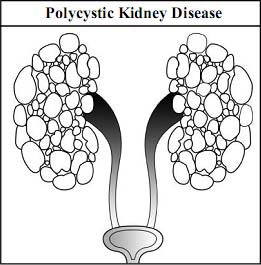 Polycystic Kidney Disease